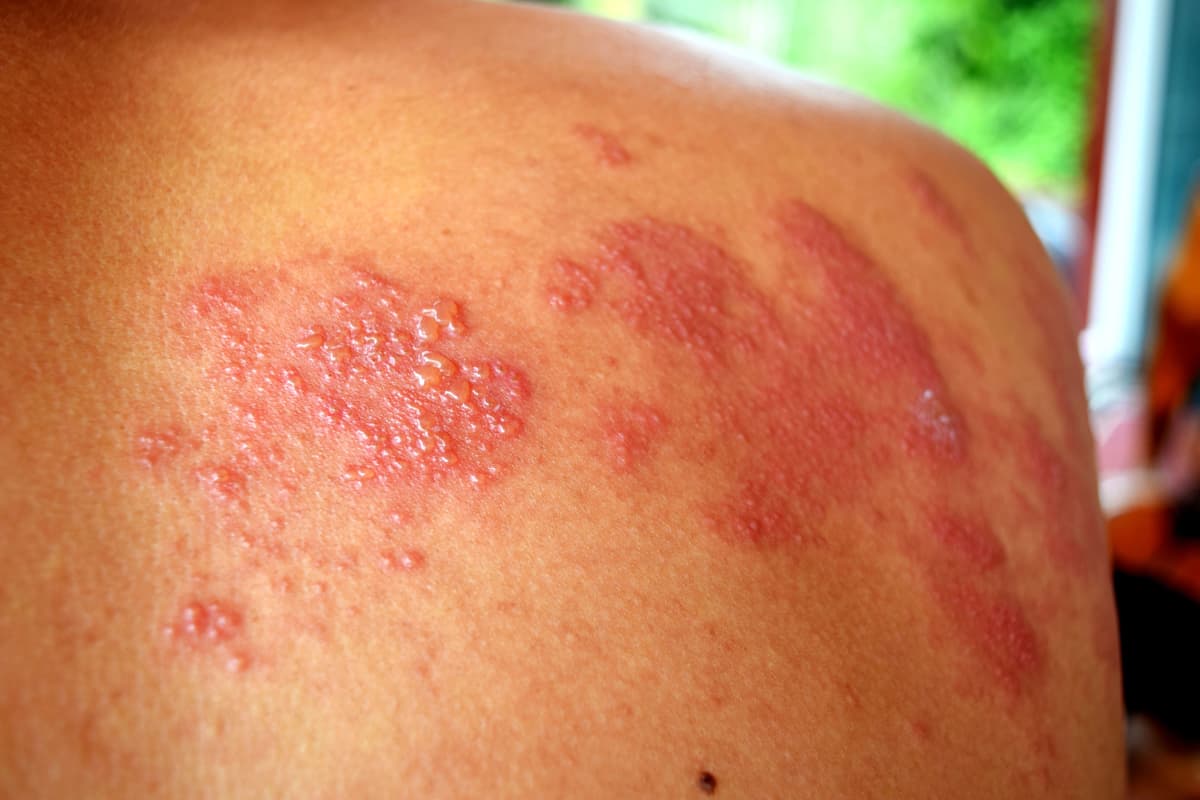 ¿Qué tan grave es el Herpes Zóster?