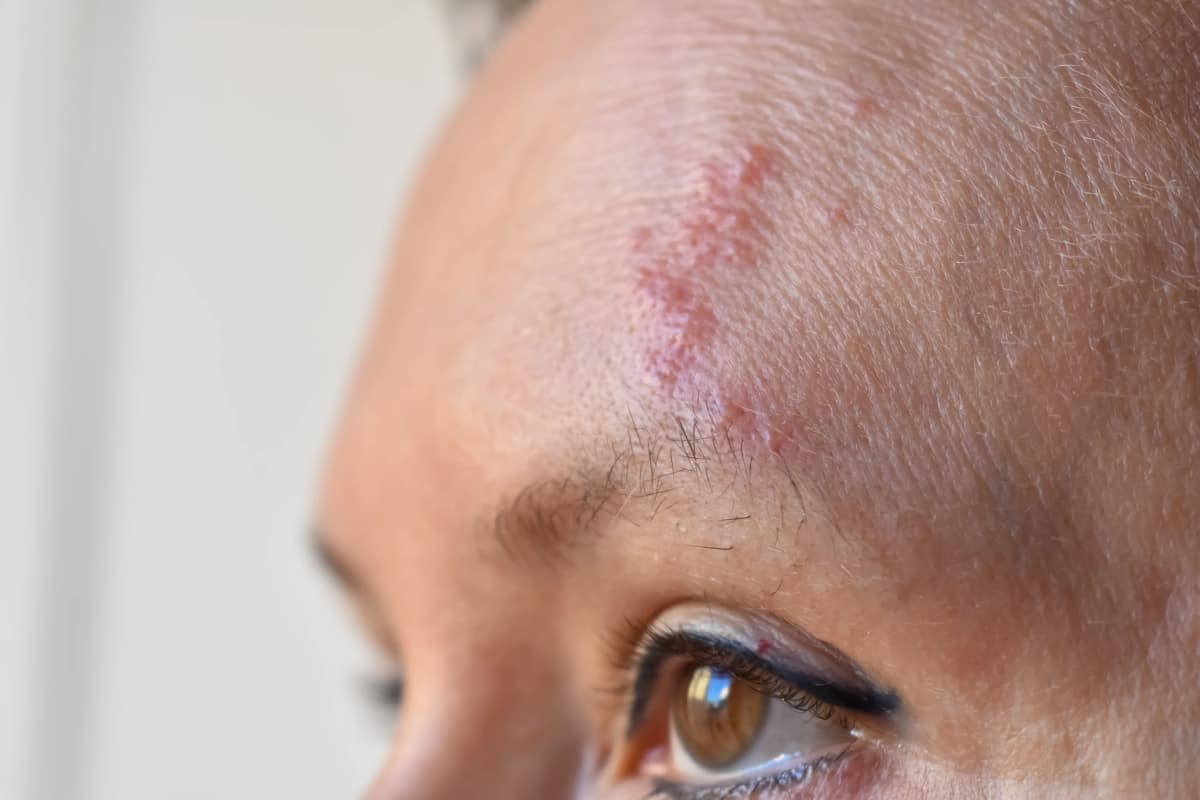 ¿Cuánto dura el virus del Herpes Zóster?