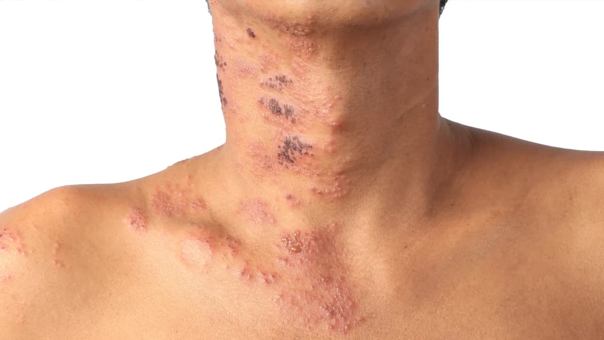 Herpes Zóster: ¿por qué las personas con enfermedades crónicas están en mayor riesgo?