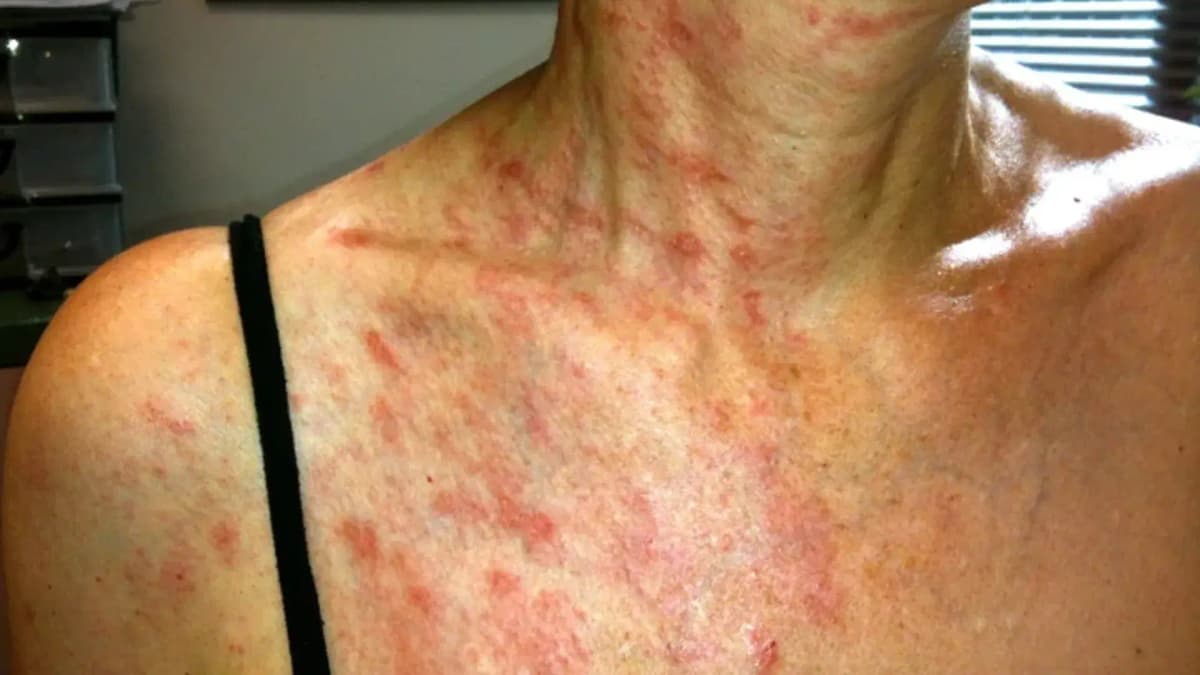 Síndrome de Ramsay Hunt: ¿qué es y cuánto dura?