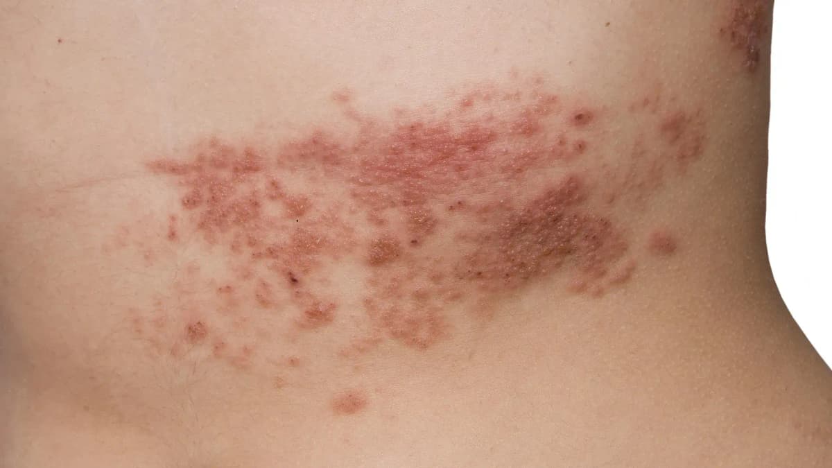 Síntomas del Herpes Zóster: cuáles son y cómo evoluciona el virus